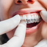 Bagues ou aligneurs : quel dispositif d'orthodontie choisir pour les adultes ?
