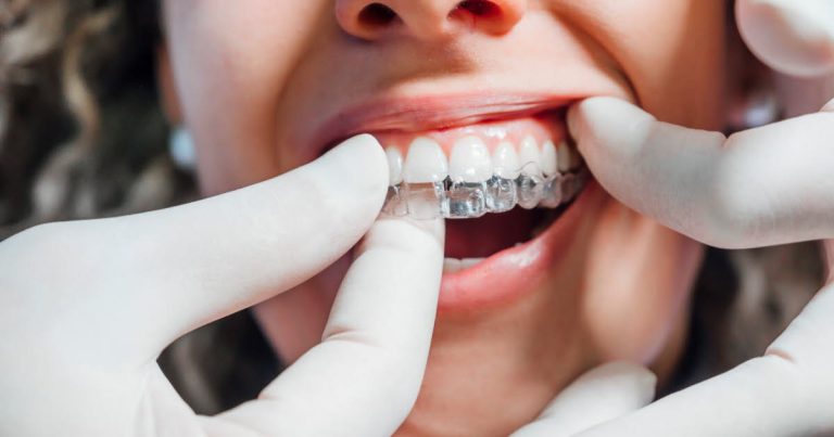 Bagues ou aligneurs : quel dispositif d'orthodontie choisir pour les adultes ?