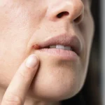 Traitements naturels efficaces contre l'herpès : Guide pratique