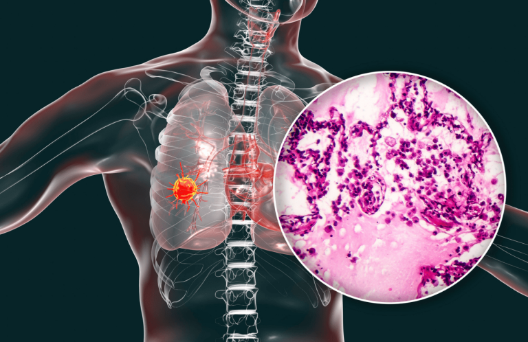 Comment une nouvelle approche thérapeutique pourrait atténuer les séquelles des pneumonies virales