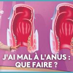 Différences cliniques entre crise hémorroïdaire et fissure anale en France.