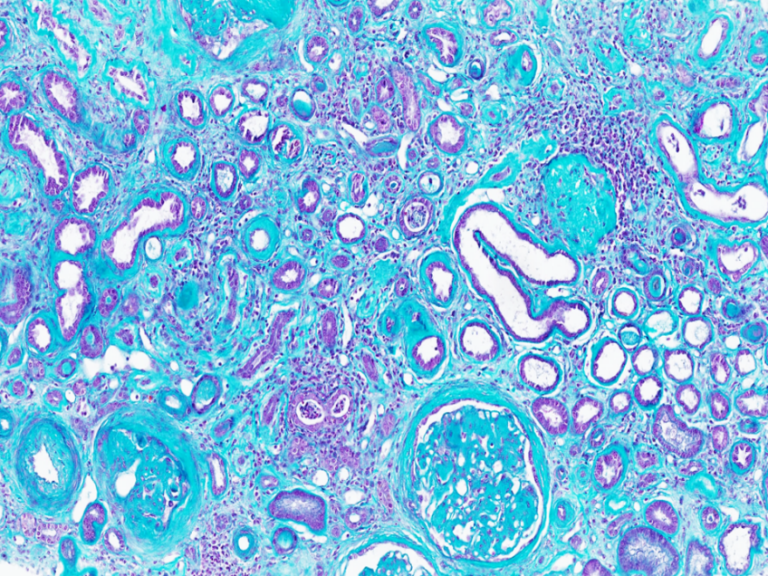 Maladies rénales chroniques : le cercle vicieux de l&rsquo;inaction politique
