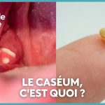 Mauvaise haleine et picotement dans la gorge : le caséum identifié comme cause possible.