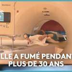 Scanner thoracique : une avancée pour la détection précoce du cancer du poumon en France.