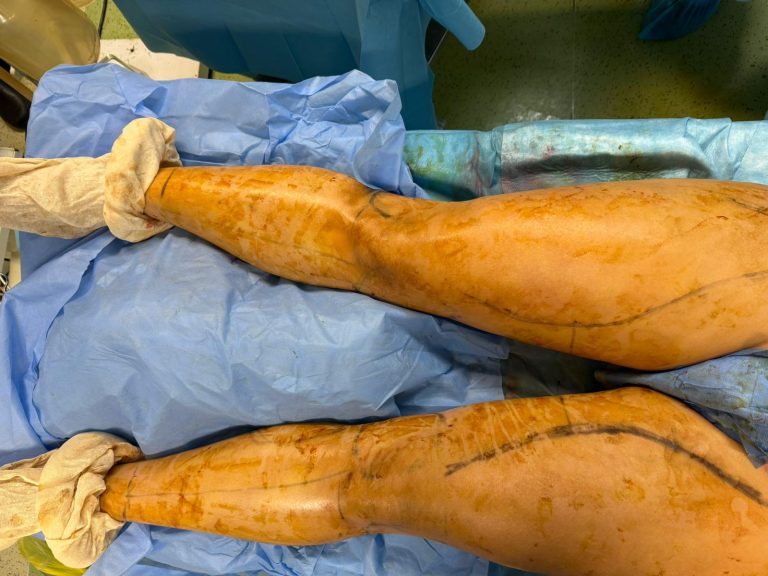 Pourquoi le « 4D Lipo » n’est pas recommandé pour le traitement du lipœdème ?