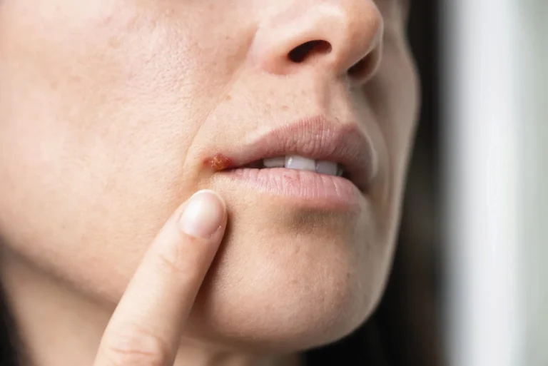 L&rsquo;Herpès : Un Virus Contagieux à Connaître