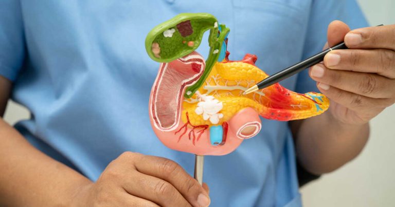 Le Cancer du Pancréas : Un Combat Inégal Contre l’Indifférence