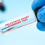 Syndrome des ovaires polykystiques : pourquoi renommer la maladie peut améliorer le diagnostic