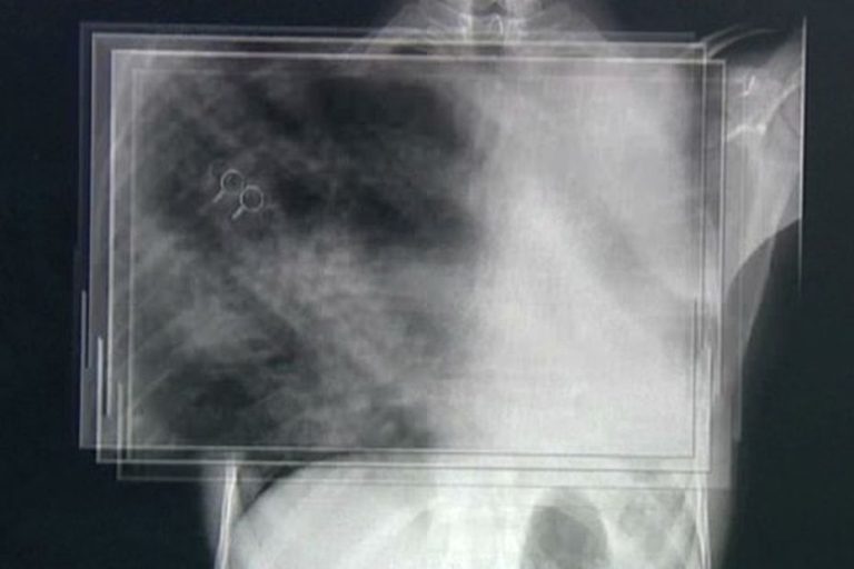 Tuberculose détectée dans le Cher, les autorités écartent le risque d&rsquo;épidémie.