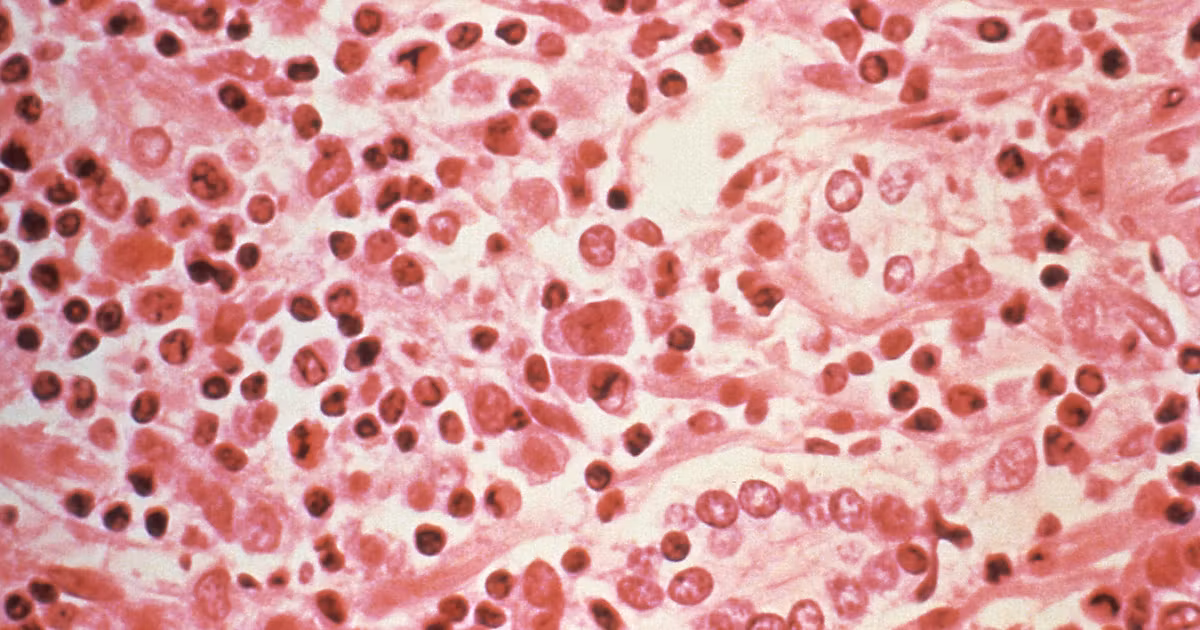 Infection à hantavirus : transmission et symptômes observés dans plusieurs régions.
