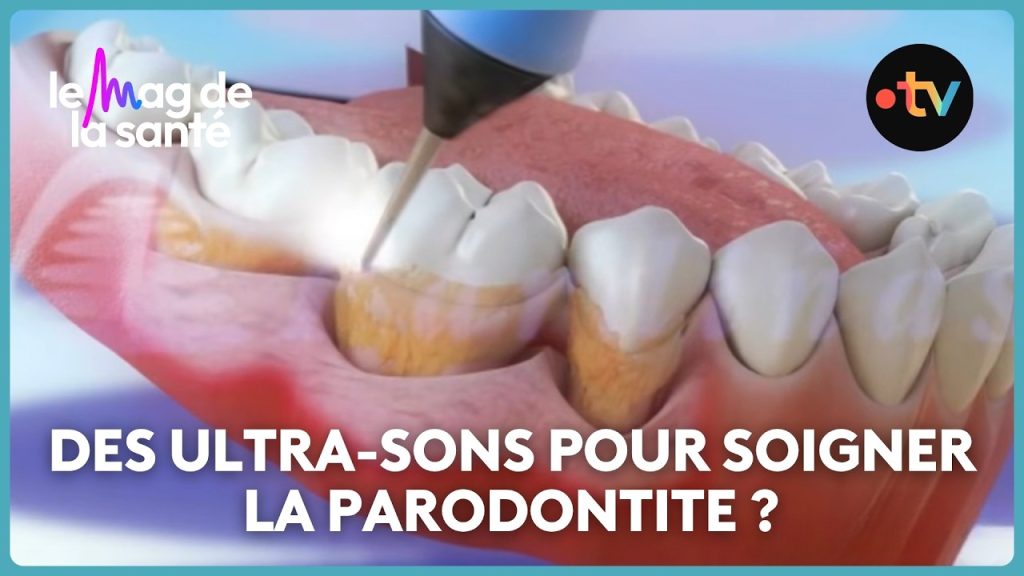 Parodontite et gingivite : méthodes de traitement recommandées par des experts dentaires.
