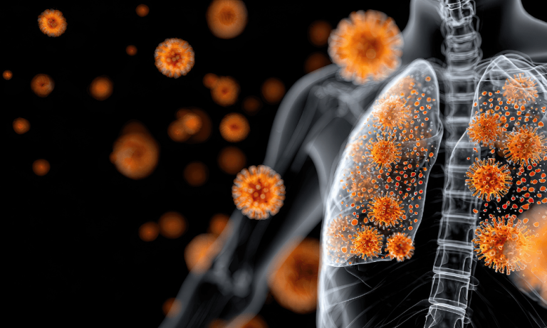 Une nouvelle stratégie thérapeutique pour réduire les séquelles des pneumonies virales en France