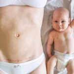 Césarienne : Impact du sexe du bébé sur les risques de maladies à long terme